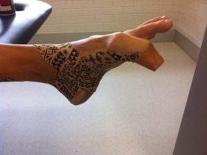 Align Orthotics Turf Toe Injury - Align Orthotics